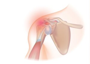 rotator cuff injury